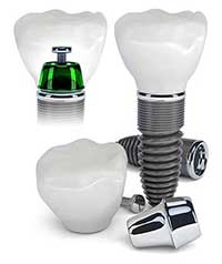 Dental Implants in Mattituck