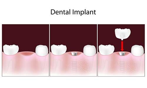 Mattituck Implant Dentistry