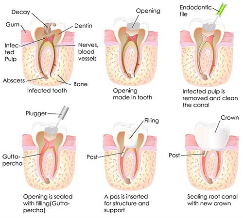 Root Canal Therapy in Mattituck