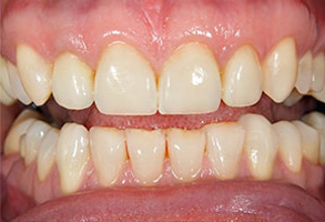Mattituck Before and After Dental Implants