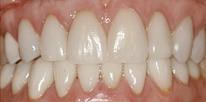 Mattituck Before and After Teeth Whitening
