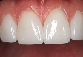 Mattituck Before and After Dental Crowns