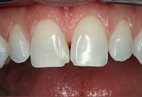 Before and After Dental Crowns in Mattituck